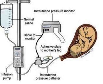 treatment for leaking amniotic fluid|Amnioinfusion: Purpose, Procedure, Results & Risks